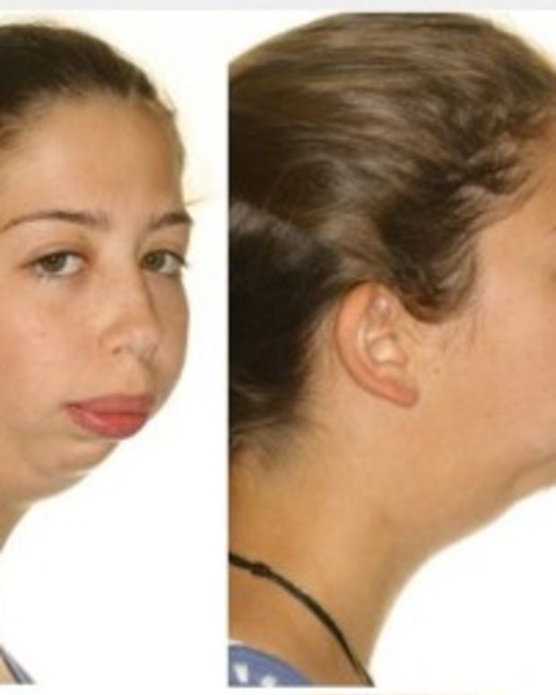 Photos Show Shocking Transformation Of Girl With Jaw Deformity ...