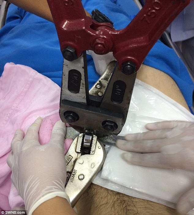 Man Has Sex Ring Removed From Penis With Bolt Cutters