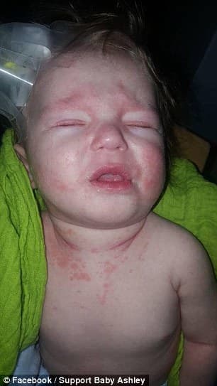 Mother Shares Photos Of Meningitis-infected Baby (photos) - Opposing Views