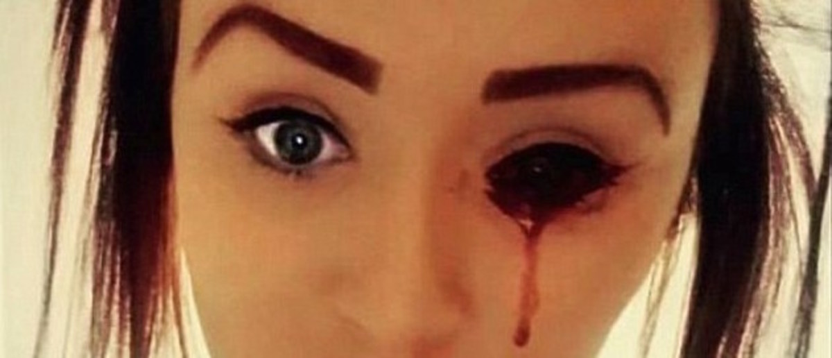 Teenager Bleeding From Eyes Baffles Doctors Photos 