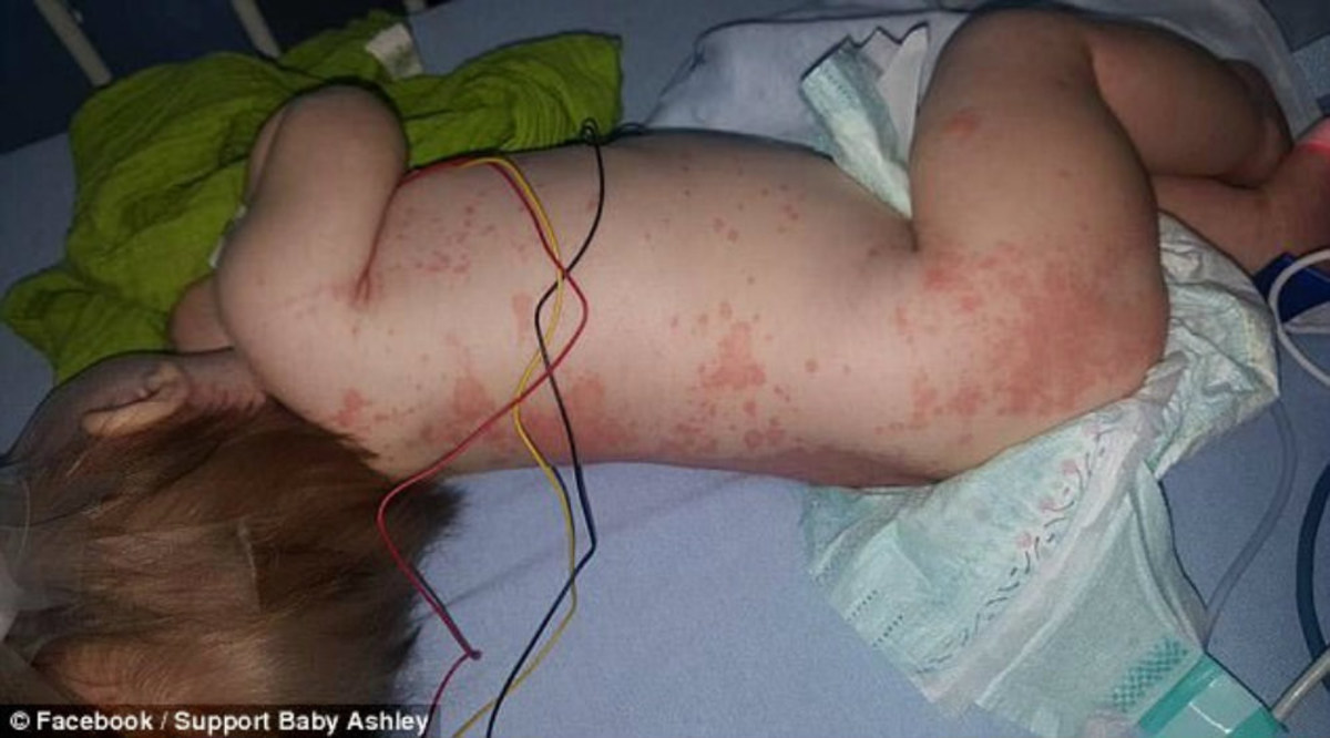 Mother Shares Photos Of Meningitis-Infected Baby (Photos) - Opposing Views