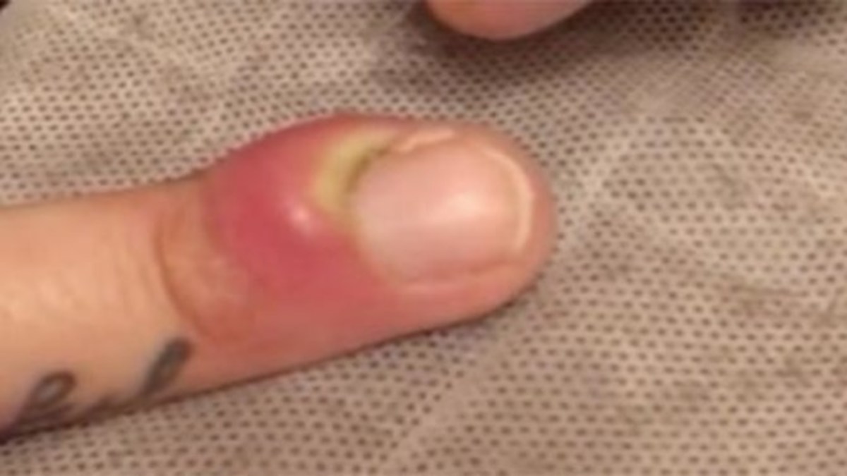 Infection Around Fingernail Skin a video of a man popping his own infected fingernail is going viral video below