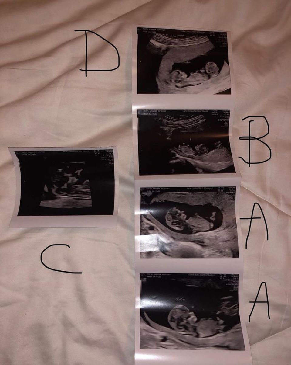 Five ultrasound photos of the identical quadruplets, Photo Credit: themarrthemerrier/Instagram