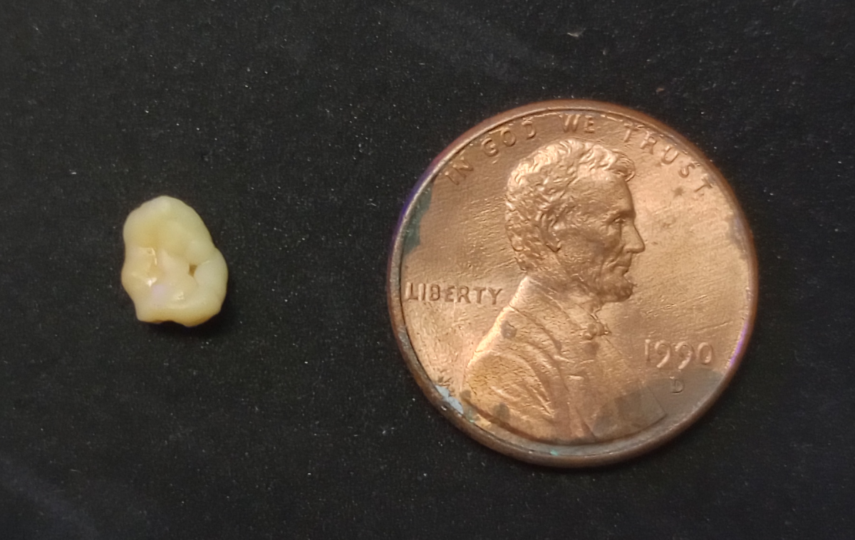 A penny next to a tonsil stone for size reference, Photo Credit: Reddit