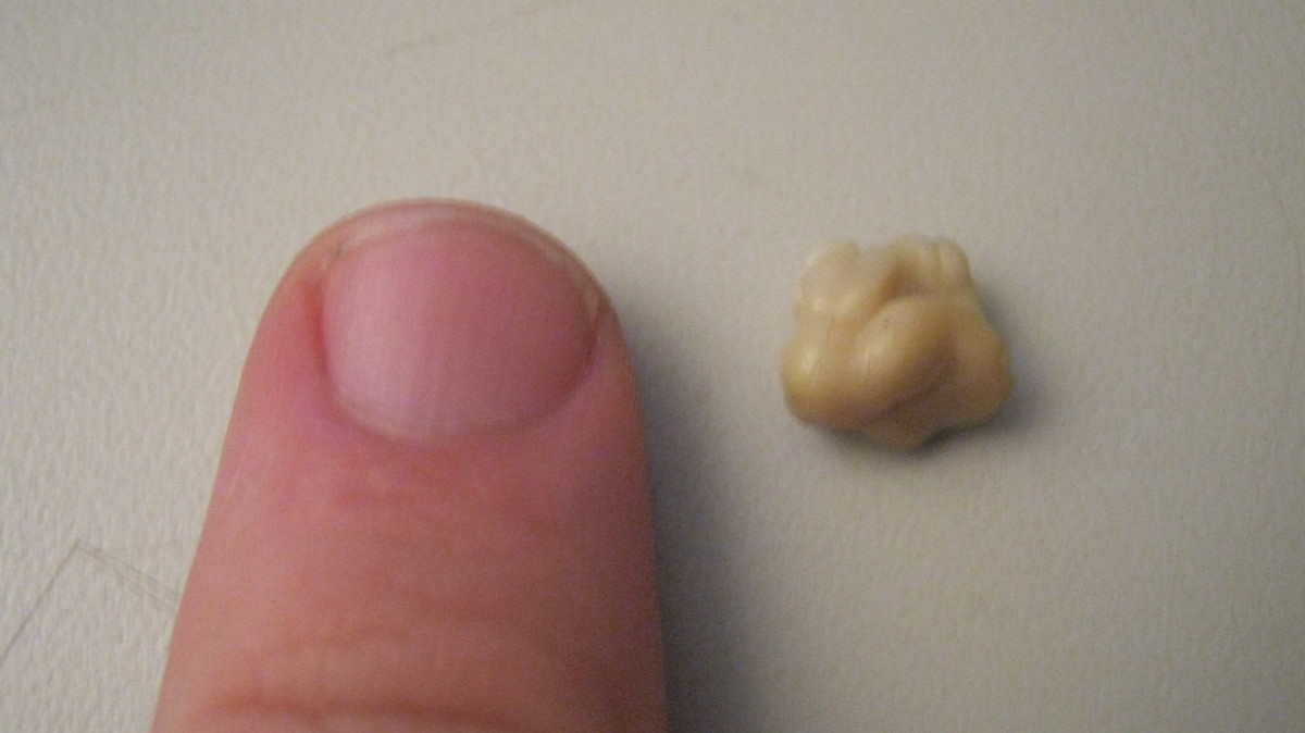 Person's finger next to a tonsil stone for size reference, Photo Credit: Wikimedia