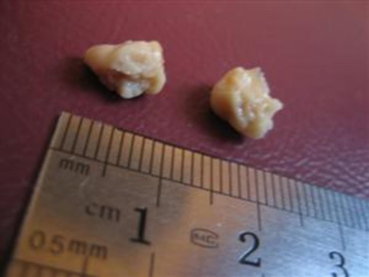 Two tonsil stones next to a ruler for size reference, Photo Credit: Wikimedia