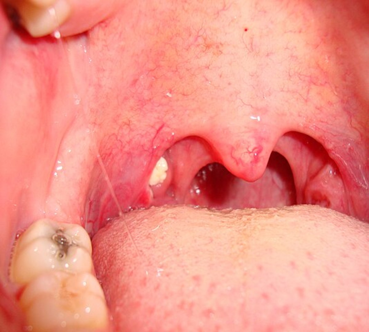 A tonsil stone lodged in the back of a person's throat, Photo Credit: Wikimedia