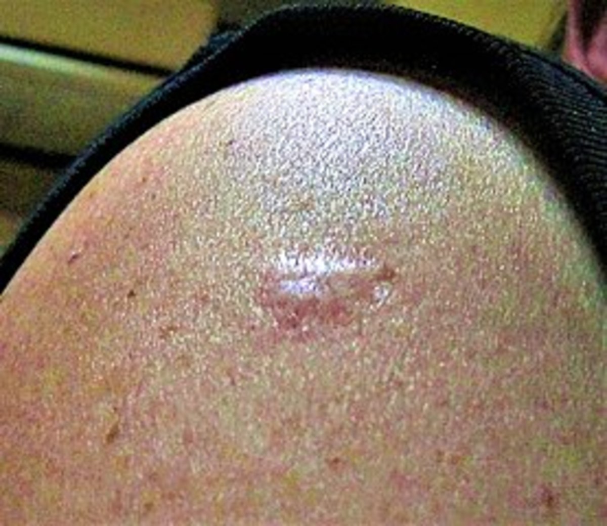 Closeup of a smallpox vaccine scar on someone's arm, Photo Credit: Wikimedia