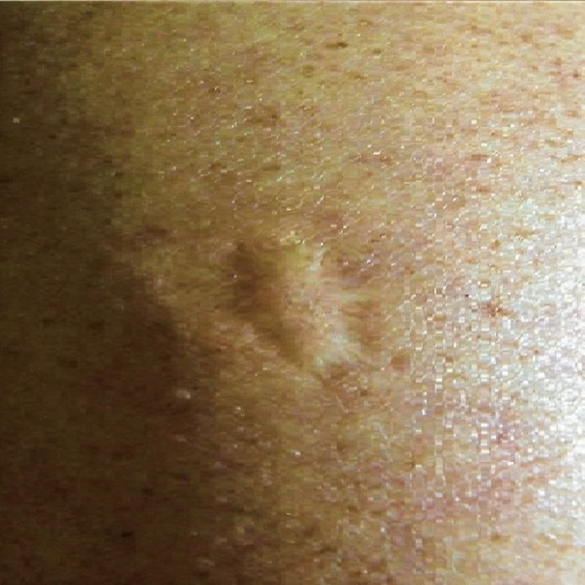 Closeup of a smallpox vaccine scar on someone's arm, Photo Credit: Wikimedia