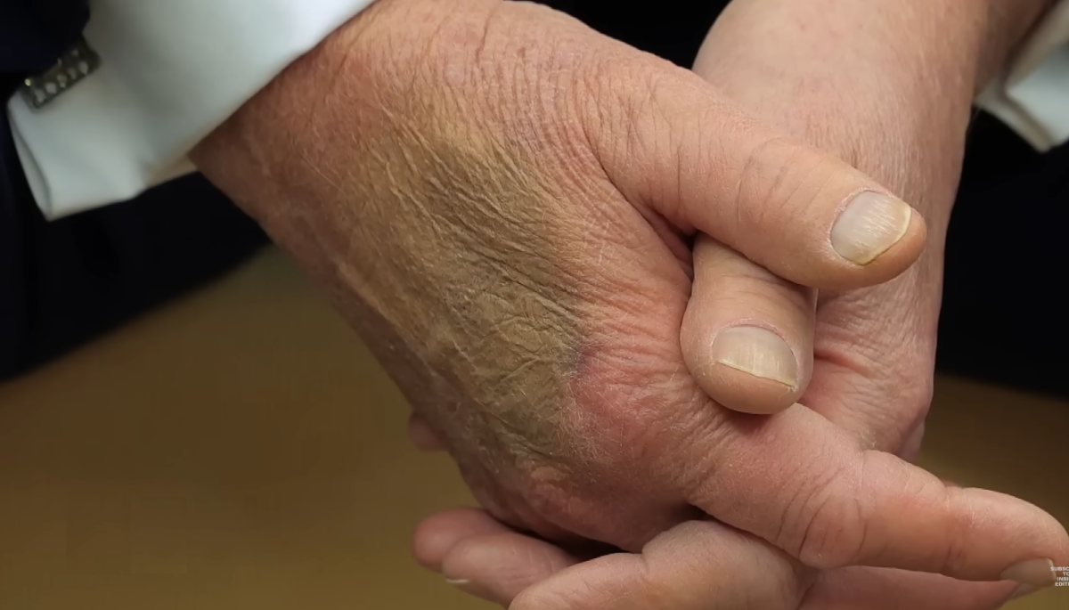 President Donald Trump's hands seen with bruise, Photo Credit: Inside Edition/Youtube